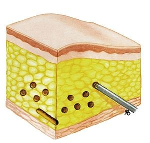 Clinimedspa - diagramme couche de peau liposuccion