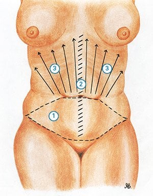 Redrapage Abdominal / Abdominoplastie diagramme