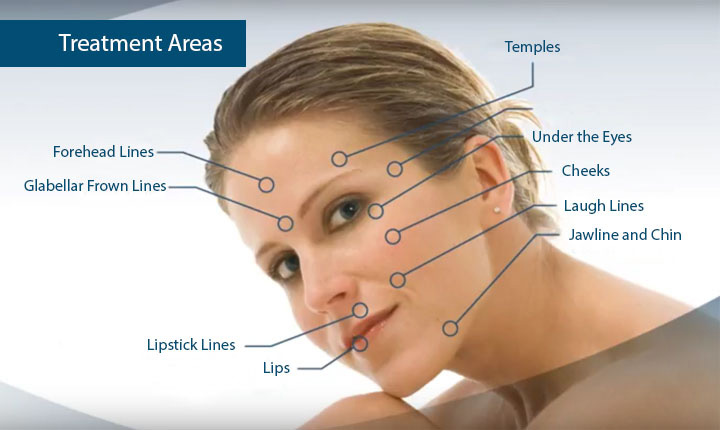 Hyaluronic Acid Treatment areas