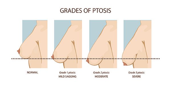 Breast Lift Grades of Ptosis