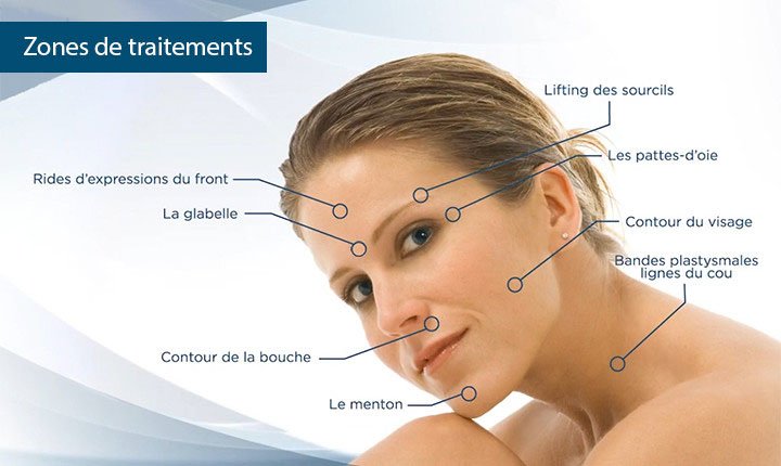 Clinimedspa - Diagramme sites d'injection de Botox (bouche, front, yeux, visage, menton)