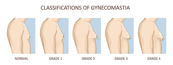 Gynecomastia 4 degrees of severity