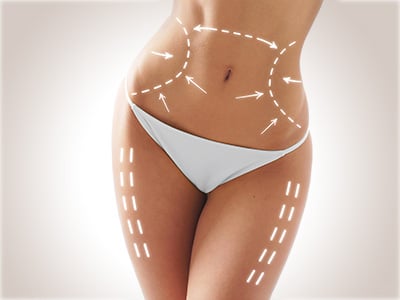Abdominoplastie - Liposuccion - Raffermir la peau - Skin Firming - Bodytite, Factite, Accutite treatments