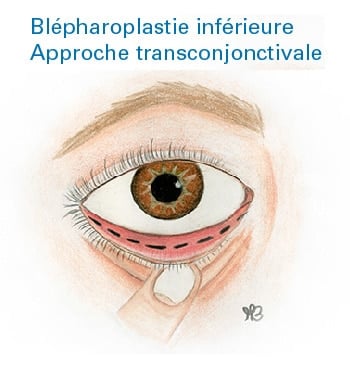 Clinimedspa - Diagramme blépharoplastie inférieure, approche transconjonctivale