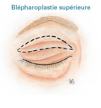 Clinimedspa - Diagramme blépharoplastie supérieure