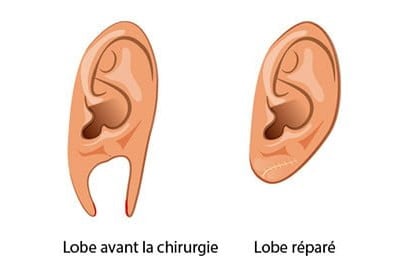 Réparation lobe d'oreille
