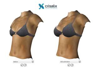 Simulation d'augmentation mammaire Crisalix en 3D avec maillot