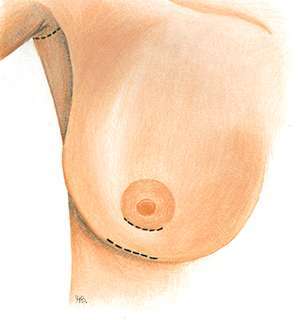 Clinimedspa - diagramme des 3 incisions pour une augmentation mammaire