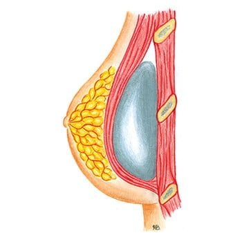 Clinimedspa - diagramme augmentation mammaire avec implant sous le muscle (position rétropectorale)