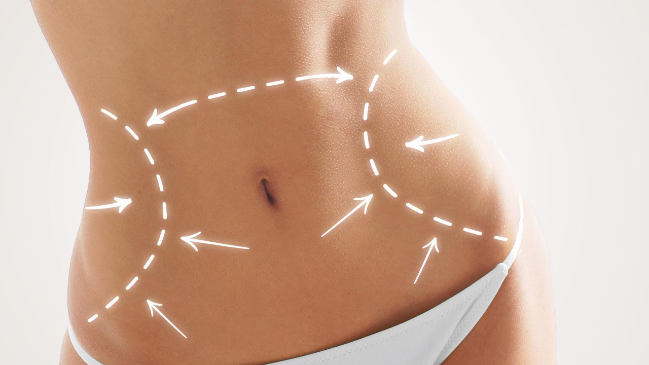 Abdominoplastie - Liposuccion du ventre ou l'abdominoplastie, pour éléminer les amas de gras et le relâchement de la peau