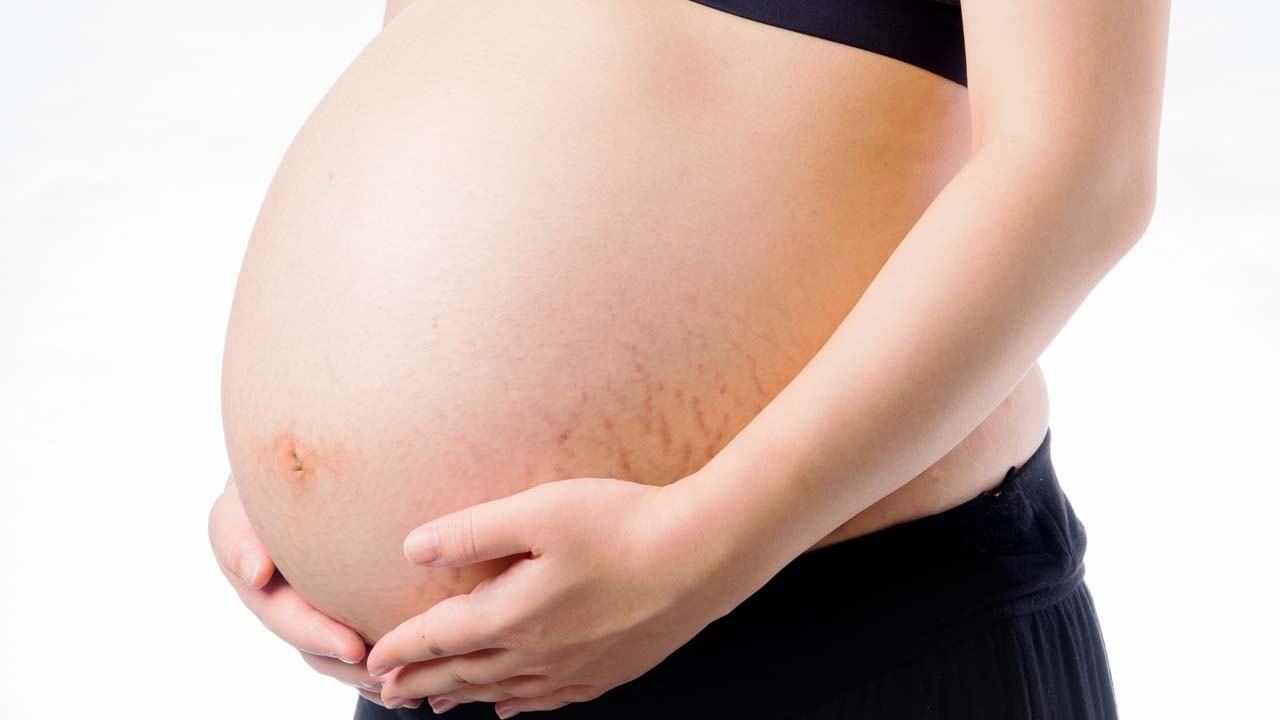 Vergeture de grossesse et relâchement de la peau abdominal