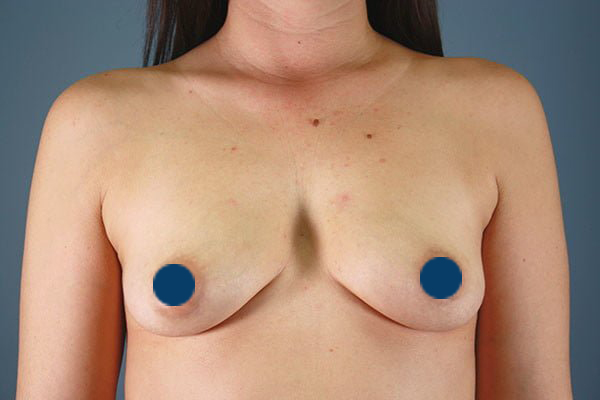 Clinimedspa augmentation mammaire slider 02 - photo avant la chirurgie